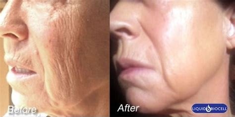 liquid biocell pure before and after