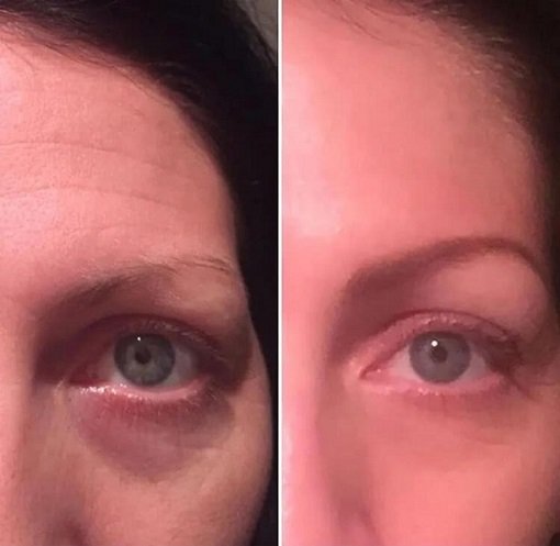 modere biocell before and after collagen